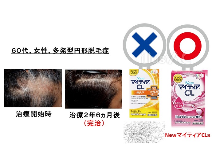 円形脱毛症　病院
